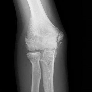 軟骨の障害~骨端症、離断性骨軟骨炎