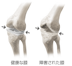 関節の障害~脱臼、亜脱臼、捻挫