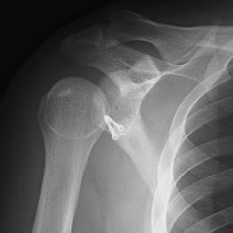肩脱臼の症状と治療および予防法