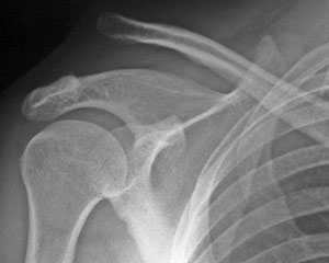 肩鎖関節脱臼の障害の症状と治療および予防法